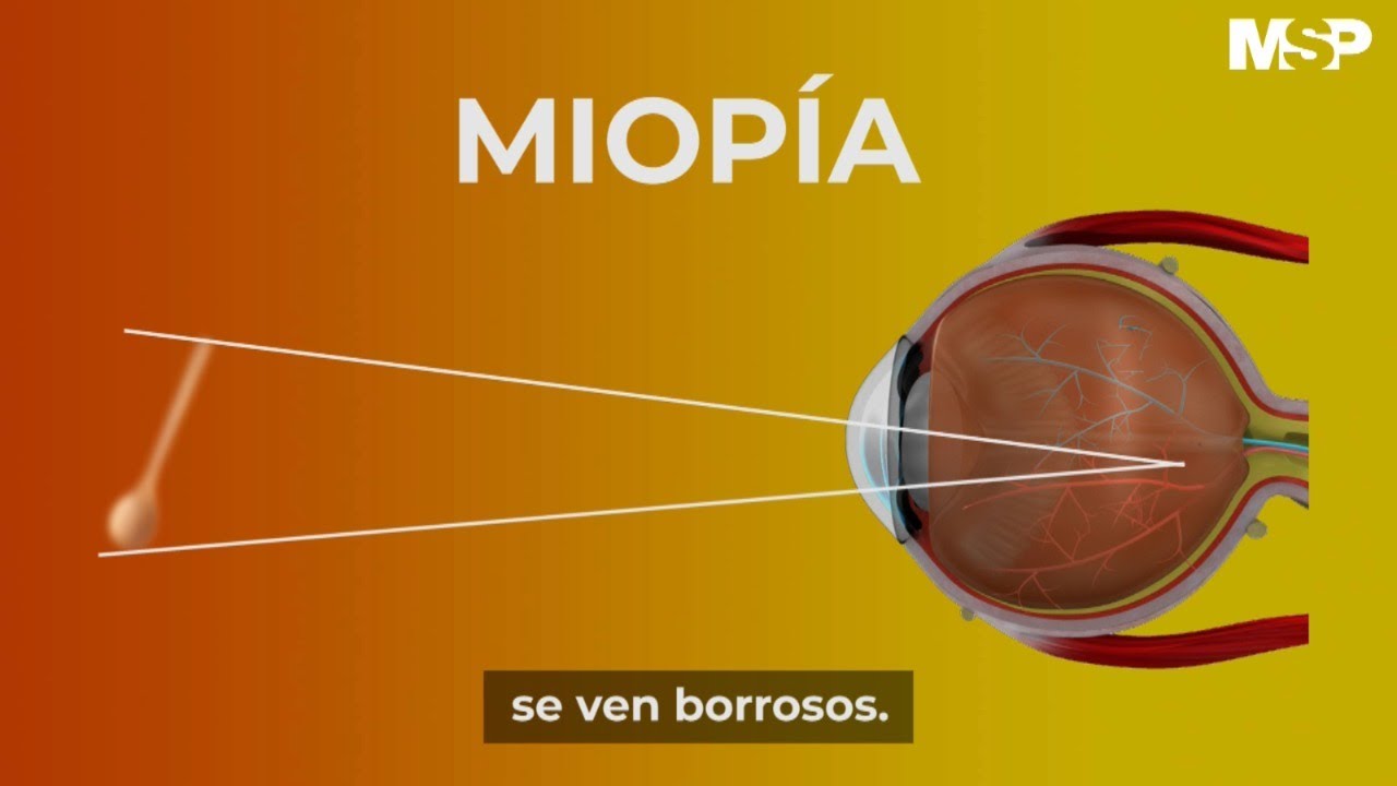 la magnitud de la miopía se mide en